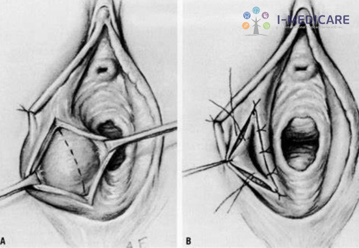 Mổ viêm tuyến Bartholin bao lâu thì khỏi? Điều cần biết trước mổ - ảnh 3