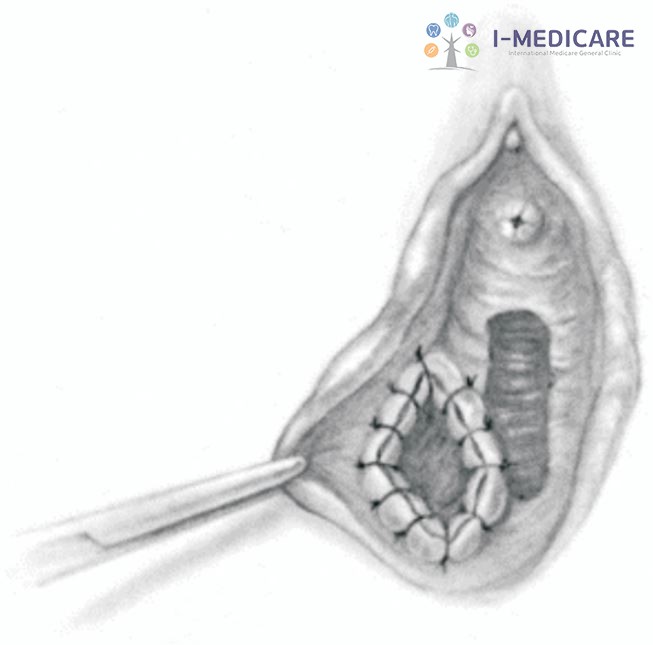 Mổ viêm tuyến Bartholin bao lâu thì khỏi? Điều cần biết trước mổ - ảnh 4