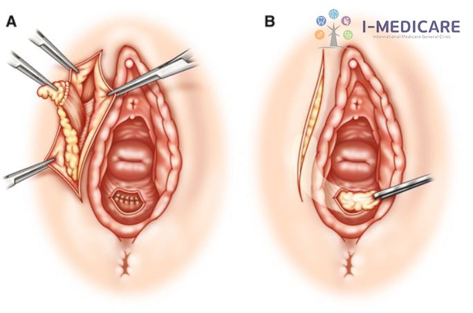 Mổ viêm tuyến Bartholin bao lâu thì khỏi? Điều cần biết trước mổ - ảnh 5