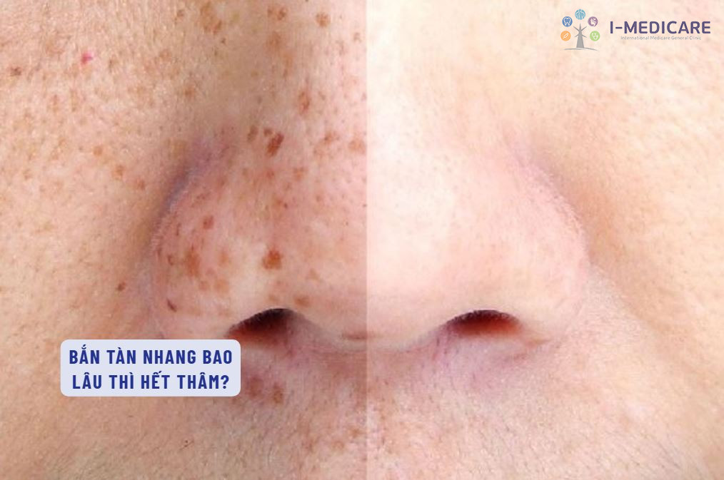 Bắn tàn nhang bao lâu thì hết thâm và cách chăm da phục hồi nhanh