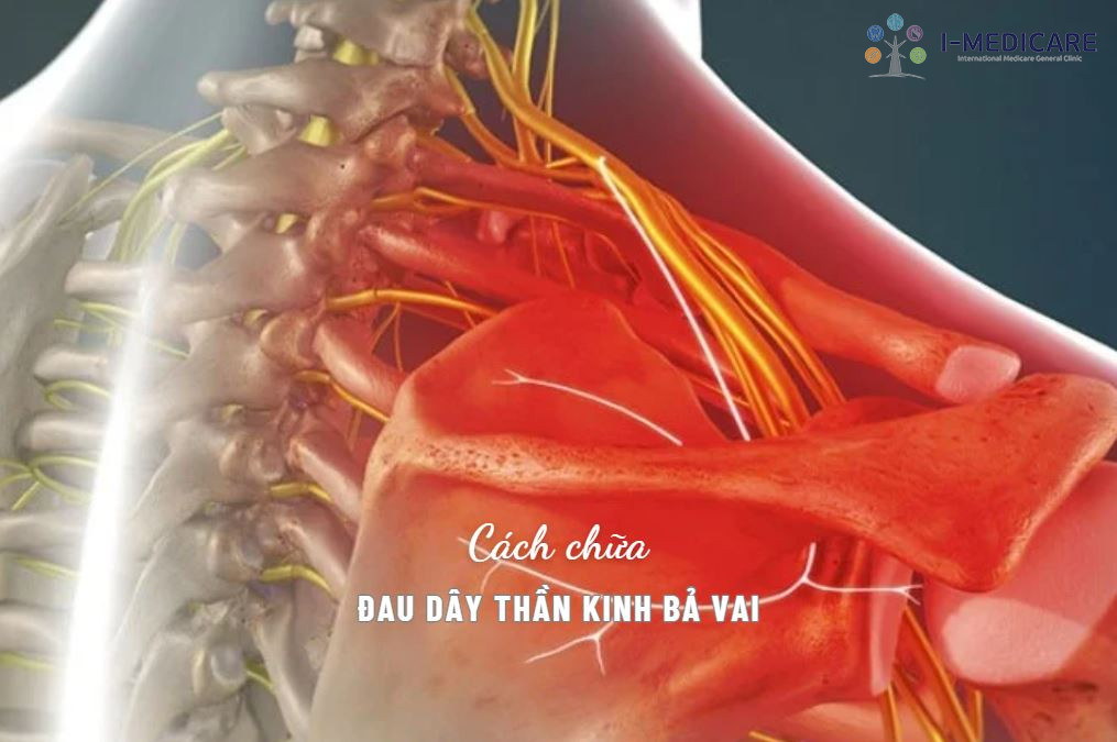 Cách chữa đau dây thần kinh bả vai hiệu quả và dễ thực hiện