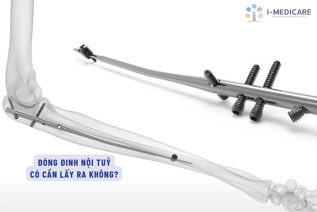 Đóng đinh nội tủy có cần lấy ra? Khi nào nên tháo an toàn nhất