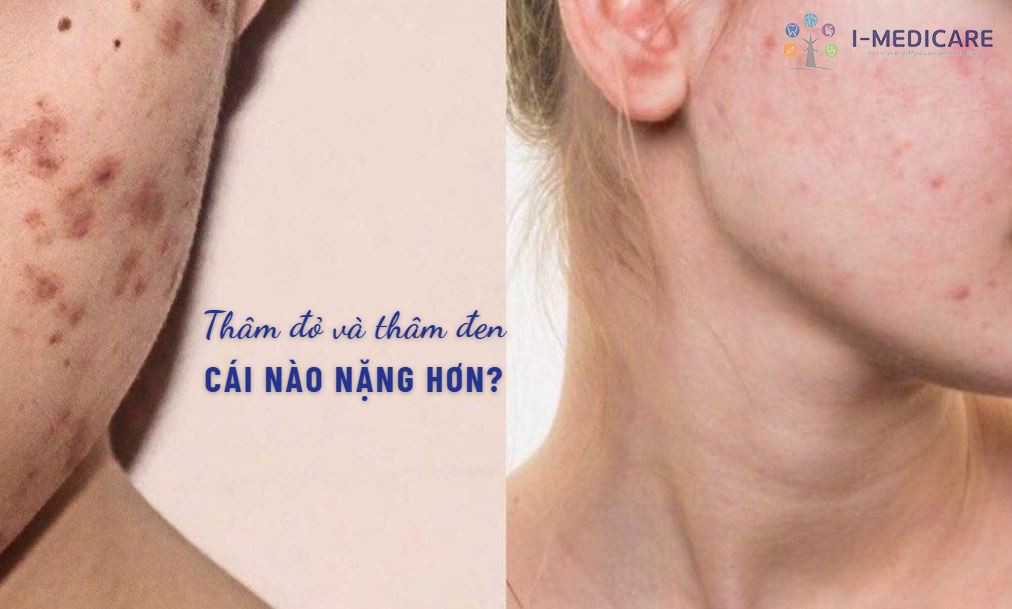 Thâm đỏ và thâm đen cái nào nặng hơn? Cách nhận biết và xử lý