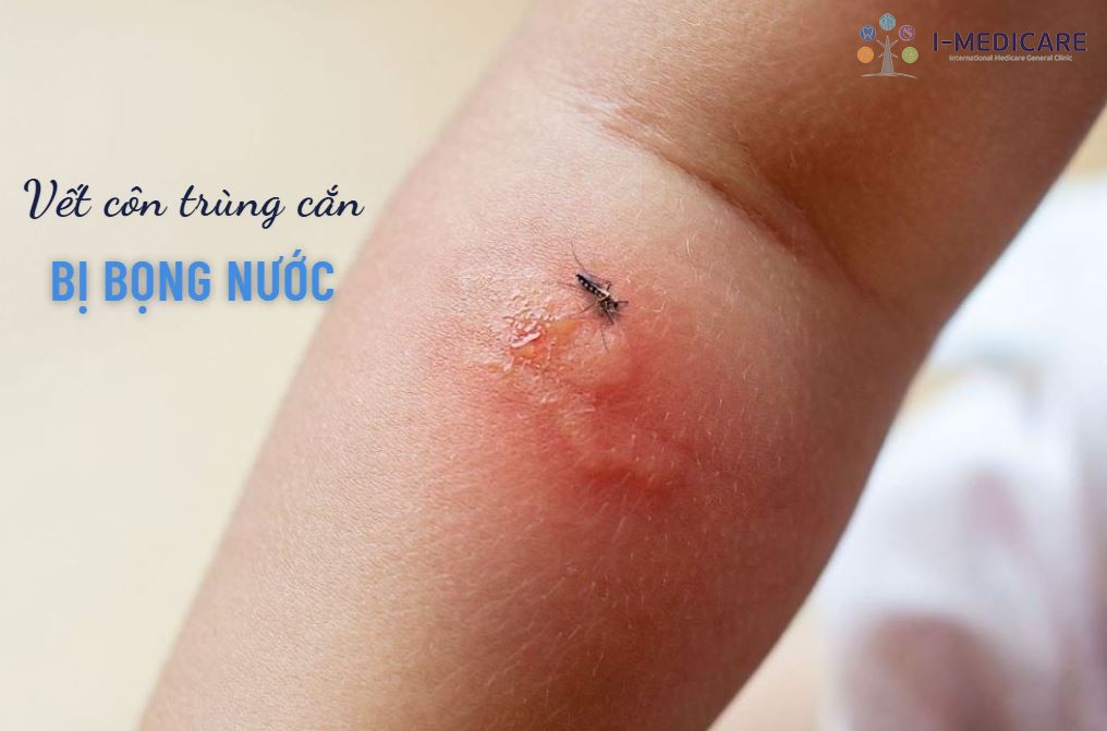 Nguy cơ từ vết côn trùng cắn bị bọng nước: Đừng chủ quan!